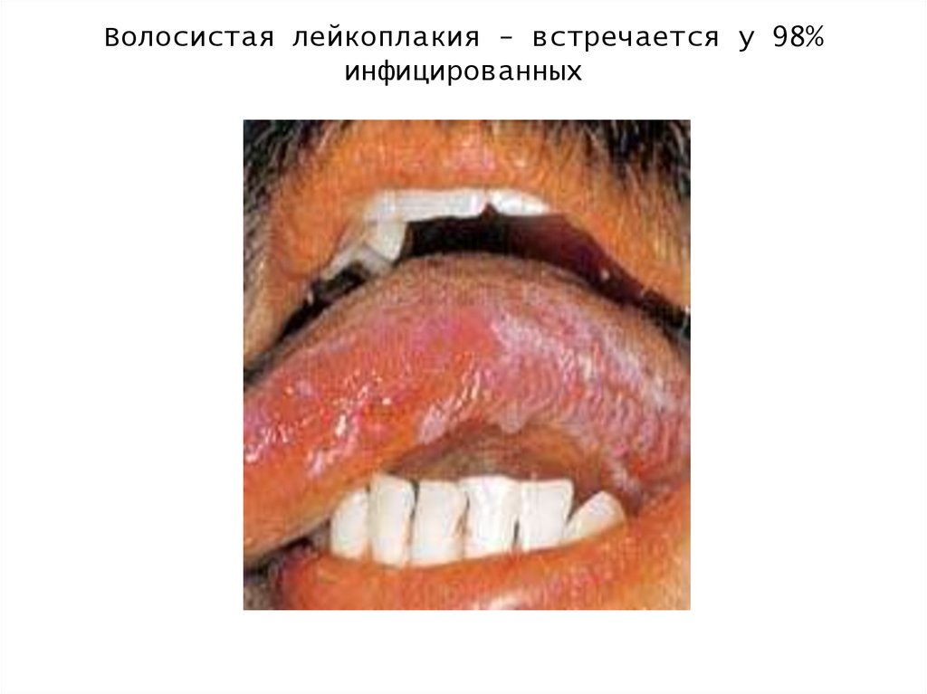 Волосистая лейкоплакия - встречается у 98% инфицированных