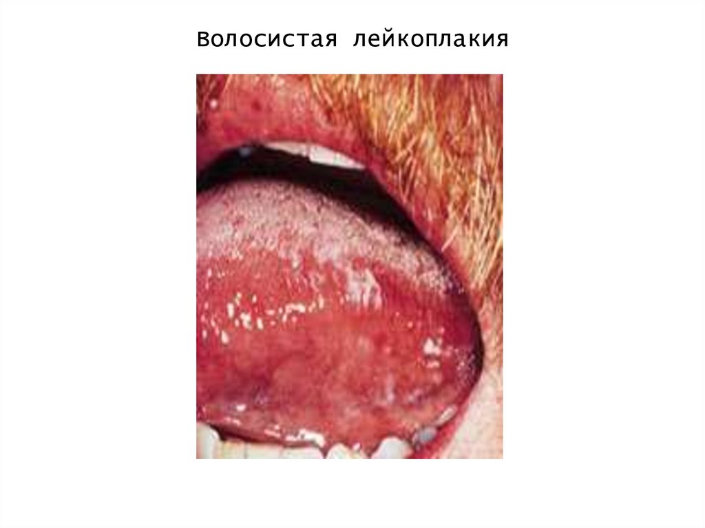 Волосистая лейкоплакия