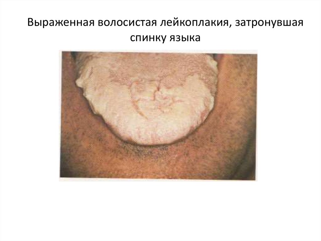 Выраженная волосистая лейкоплакия, затронувшая спинку языка