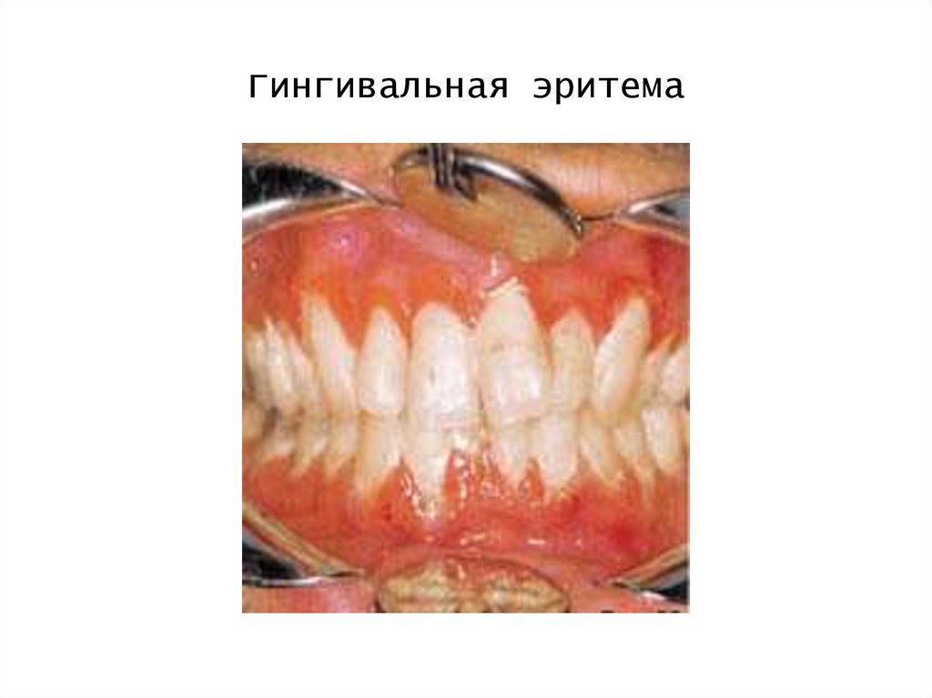 Гингивальная эритема