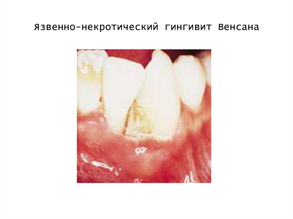 Язвенно-некротический гингивит Венсана
