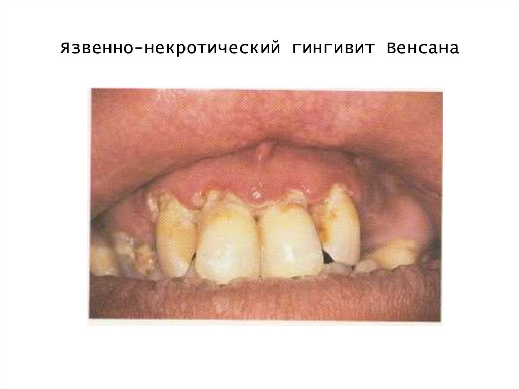 Язвенно-некротический гингивит Венсана