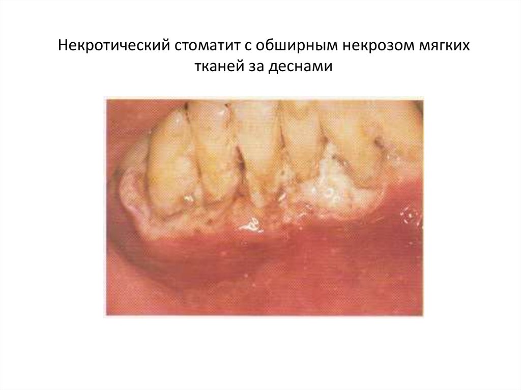 Некротический стоматит с обширным некрозом мягких тканей за деснами
