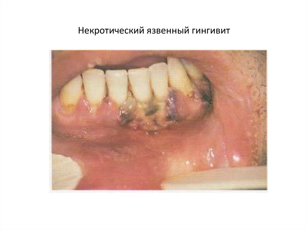 Некротический язвенный гингивит