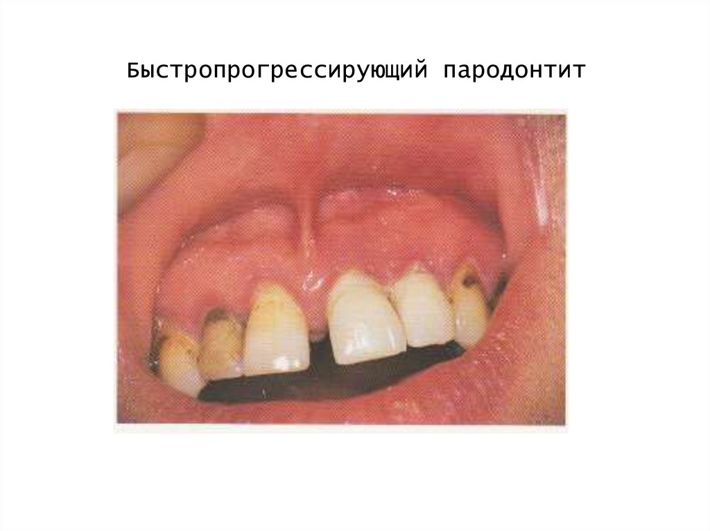 Быстропрогрессирующий пародонтит