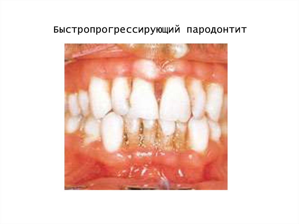 Быстропрогрессирующий пародонтит