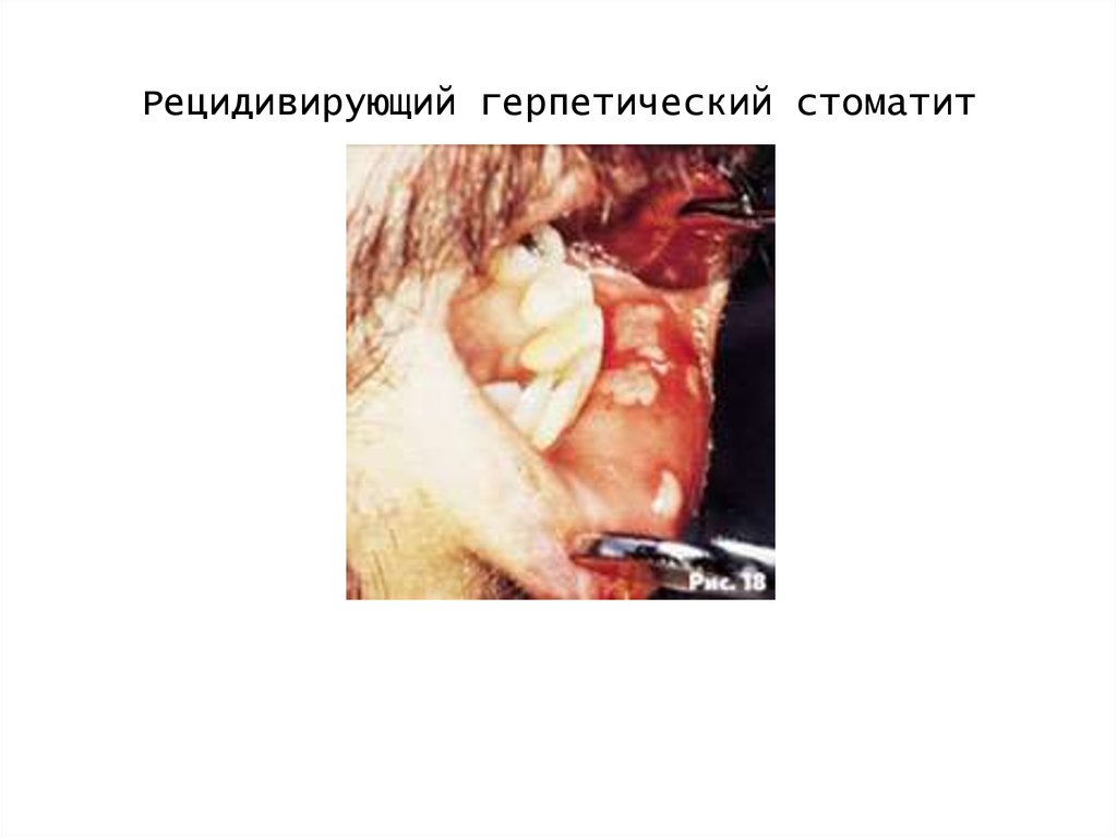 Рецидивирующий герпетический стоматит