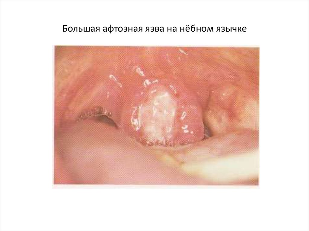 Большая афтозная язва на нёбном язычке