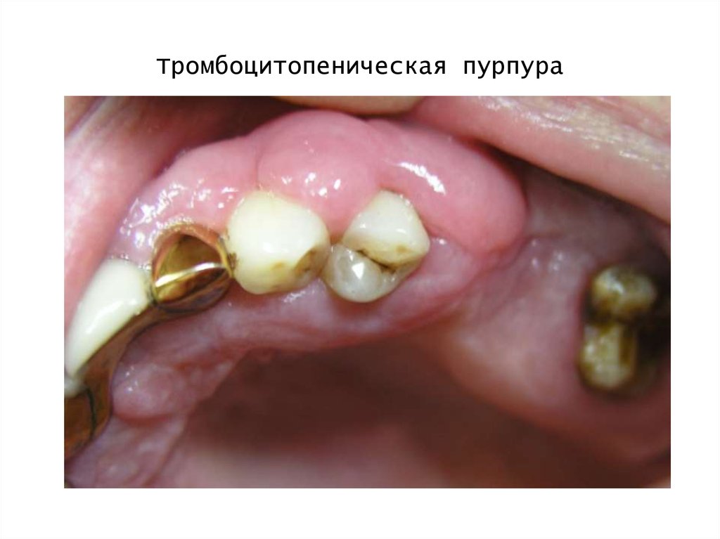 Тромбоцитопеническая пурпура