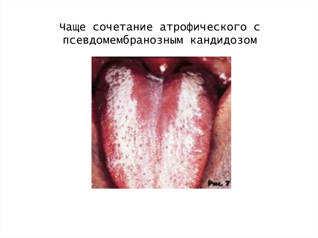 Чаще сочетание атрофического с псевдомембранозным кандидозом