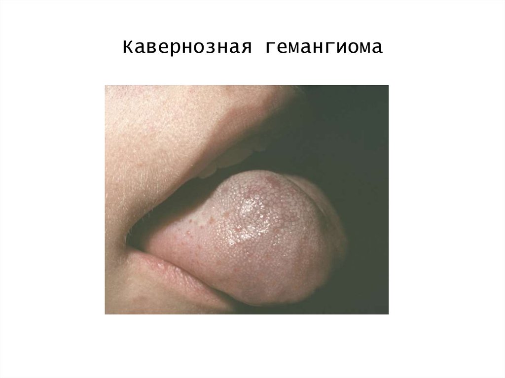 Кавернозная гемангиома