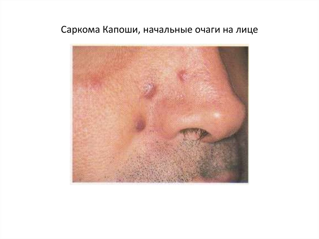 Саркома Капоши, начальные очаги на лице