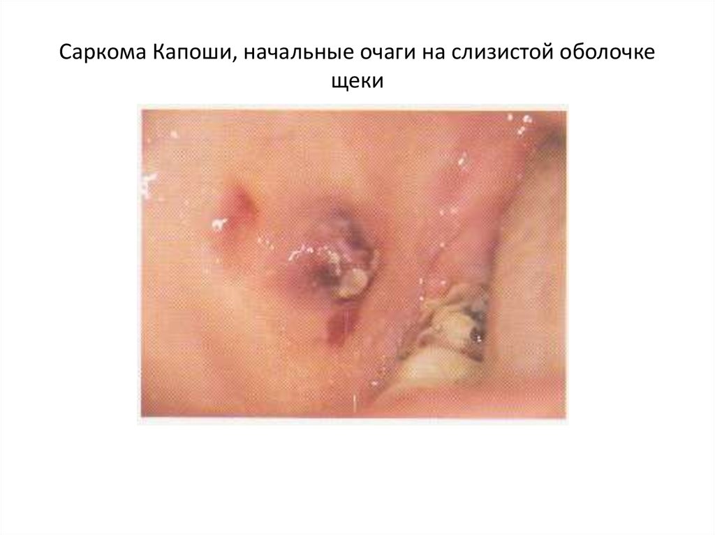 Саркома Капоши, начальные очаги на слизистой оболочке щеки