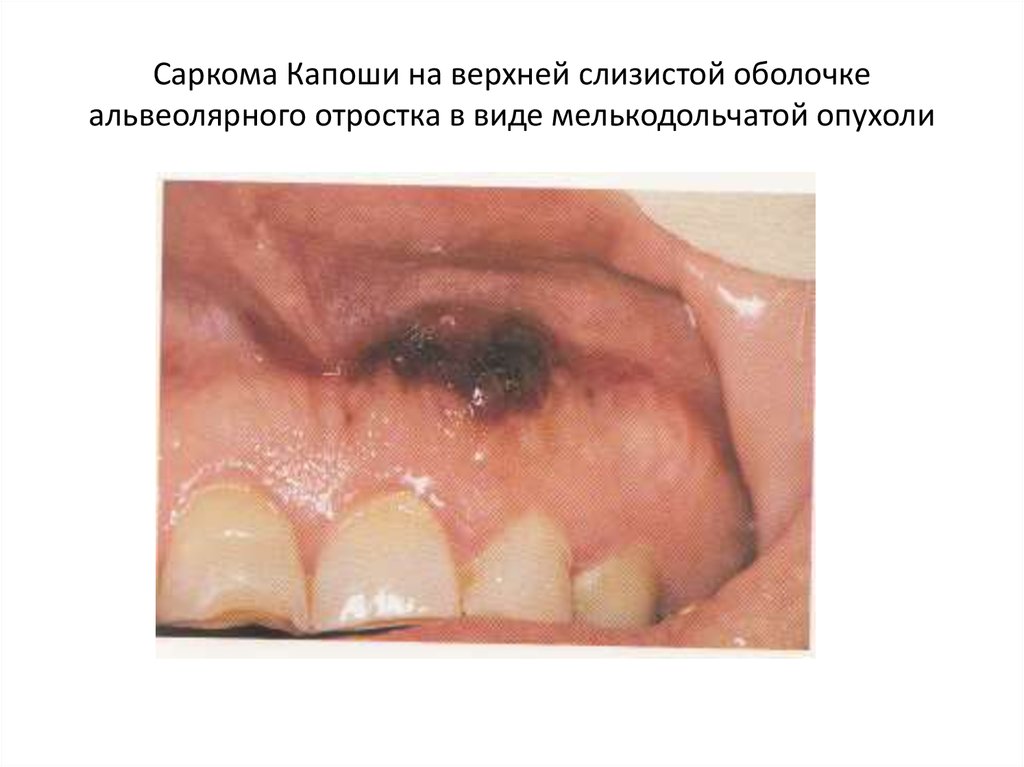 Саркома Капоши на верхней слизистой оболочке альвеолярного отростка в виде мелькодольчатой опухоли