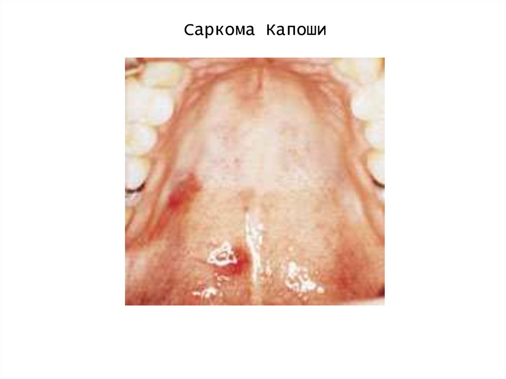 Саркома Капоши