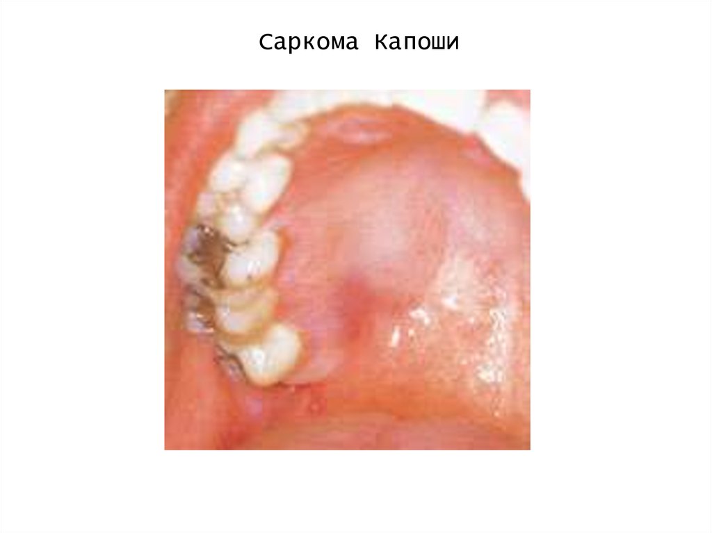 Саркома Капоши