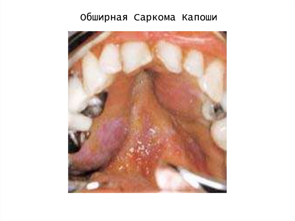 Обширная Саркома Капоши