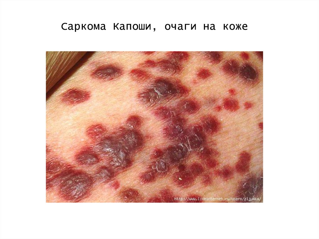 Саркома Капоши, очаги на коже
