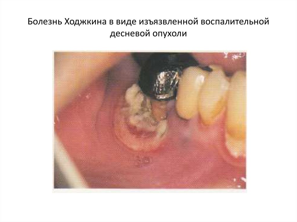 Болезнь Ходжкина в виде изъязвленной воспалительной десневой опухоли