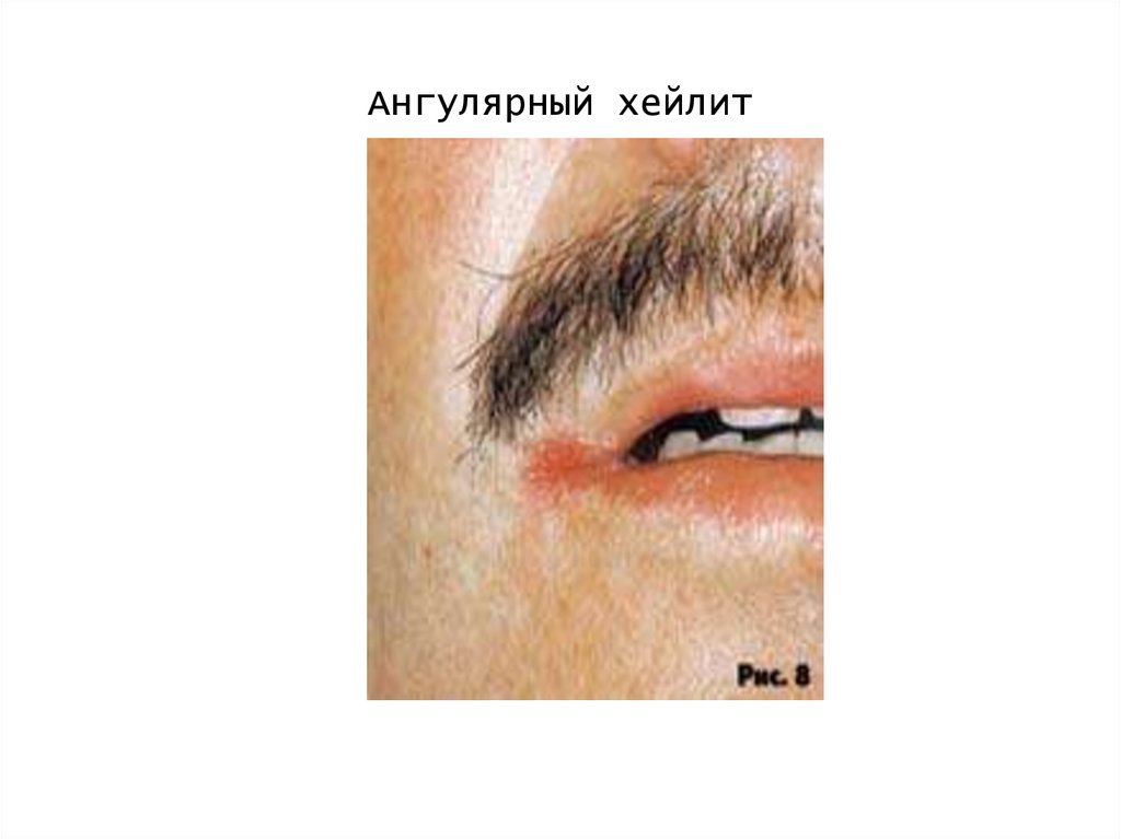 Ангулярный хейлит