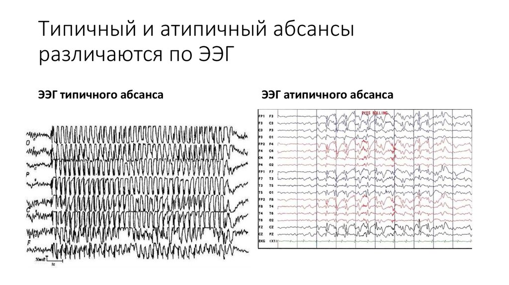 Эпилептиформные паттерны детства. Абсансная эпилепсия на ЭЭГ. Атипичные абсансы на ЭЭГ. Эпилептические паттерны на ЭЭГ. Детская абсансная эпилепсия на ЭЭГ.