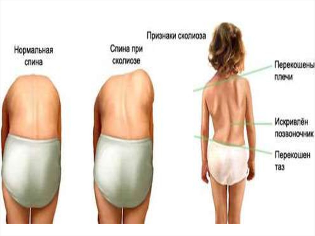 Нормальная поясница. Нормальная спина. Как выглядит нормальная спина. Спина нормального человека. Нормальная спина и нет.