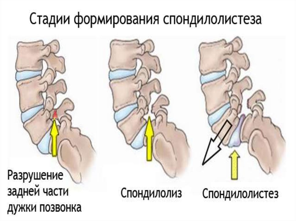 Спондилолистез. Спондилолиз и спондилолистез. Стадии спондилолистеза. Спондилолистез классификация. Степени спондилолистеза.