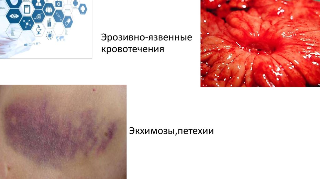 Эрозивно-язвенные кровотечения