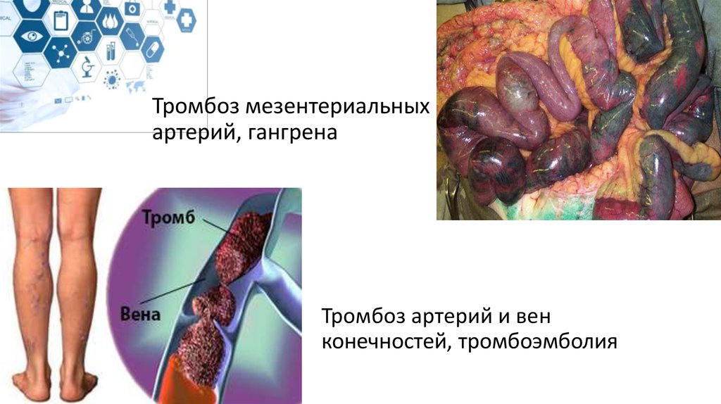 Тромбоз мезентериальных артерий, гангрена