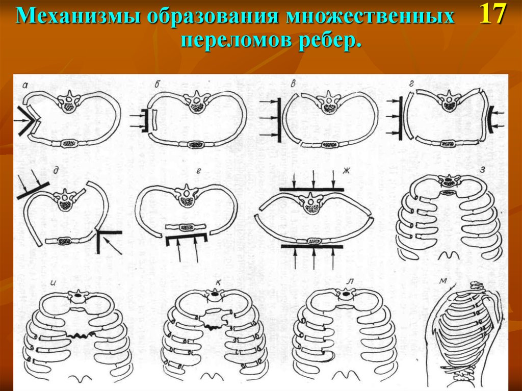 Множественные переломы ребер карта вызова