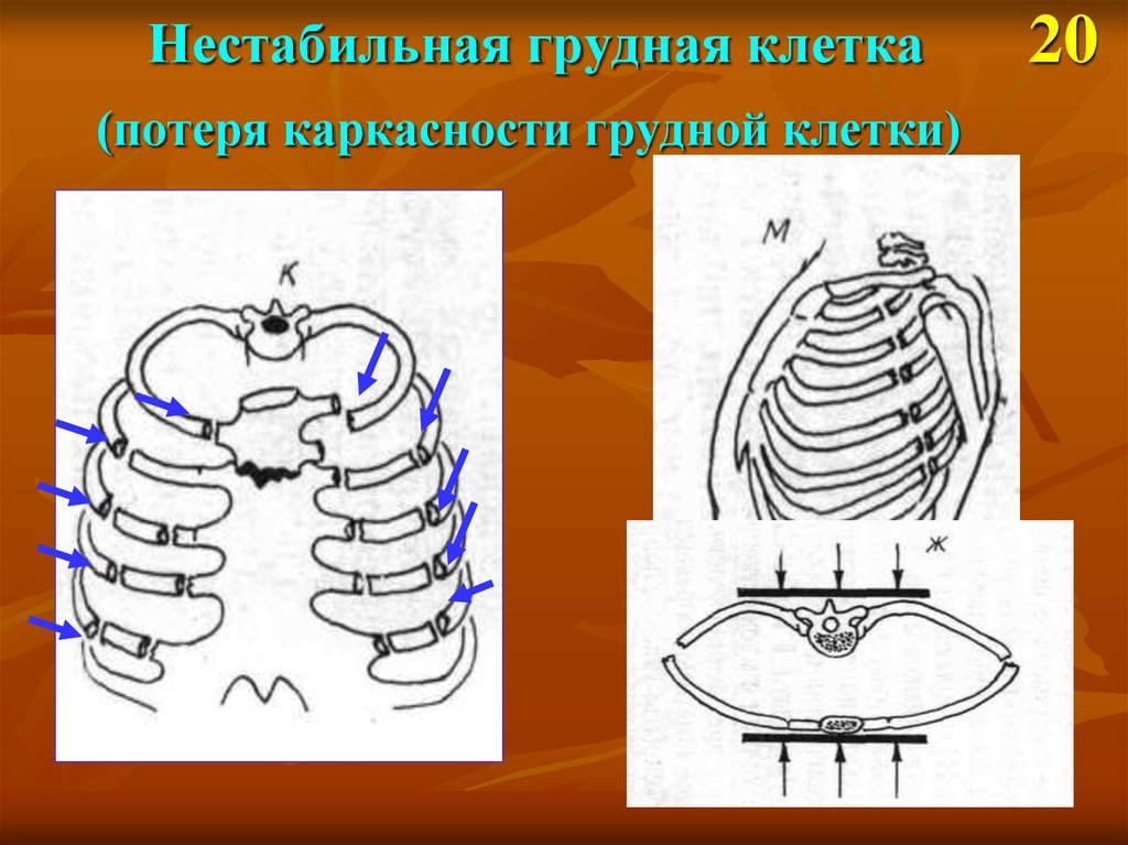 Грудная клетка презентация