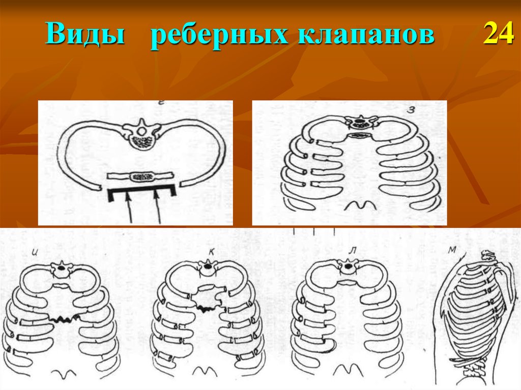 Повреждение грудной клетки презентация