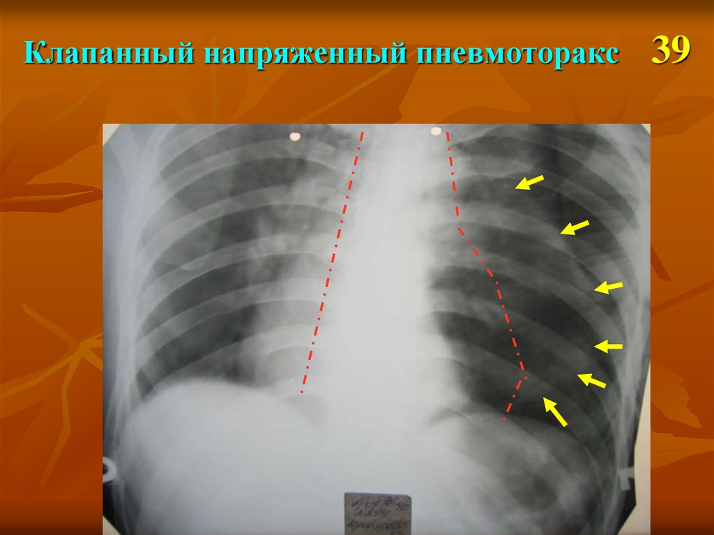 Напряженный пневмоторакс. Клапанный пневмоторакс рентгенограмма. Рентгенография органов грудной клетки при пневмотораксе. Пневмоторакс справа рентген. Напряженный пневмоторакс рентгенограмма.