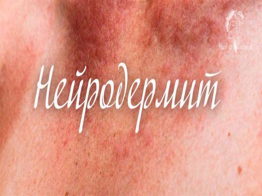 Нейродермит - презентация онлайн
