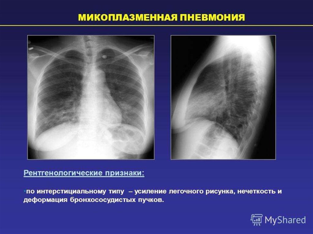 Рентген картина пневмонии