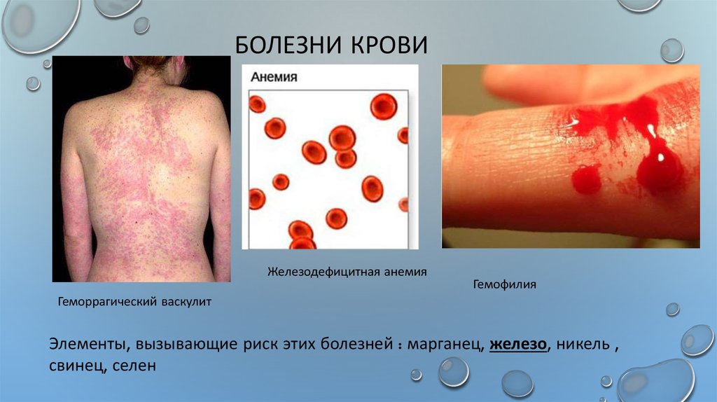 Болезни крови