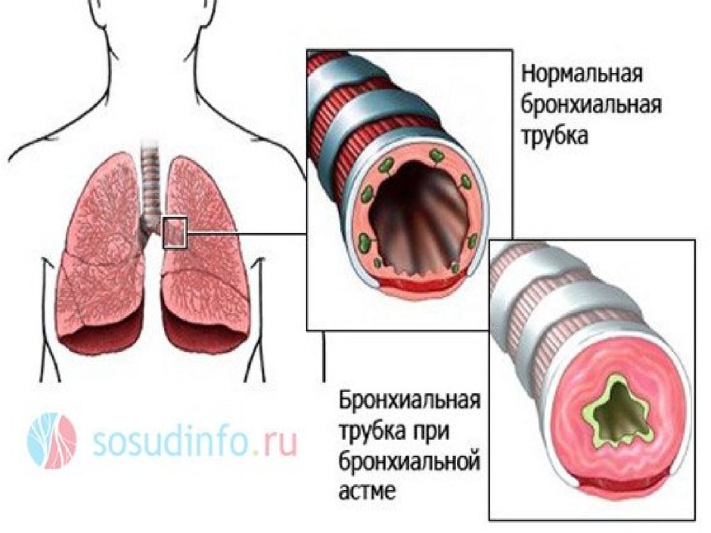 Бронхиальные заболевания. Бронхиальная обструкция и бронхиальная астма. Бронхиальная астма обструктивный синдром. Бронхиальная обструкция при бронхиальной астме. Синдром обструкции бронхов.