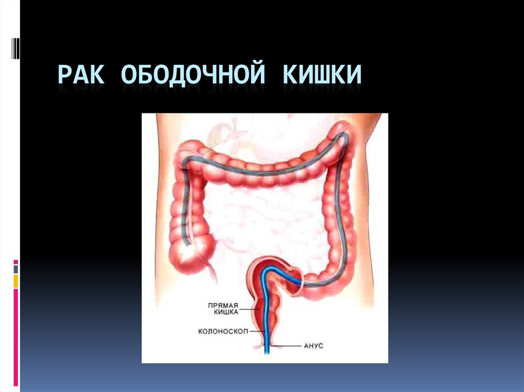 Рак толстой кишки картинки