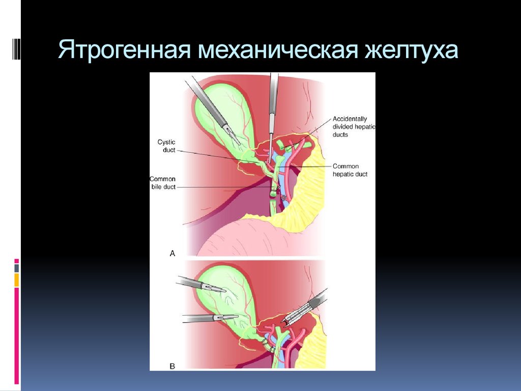 Механическая желтуха карта вызова