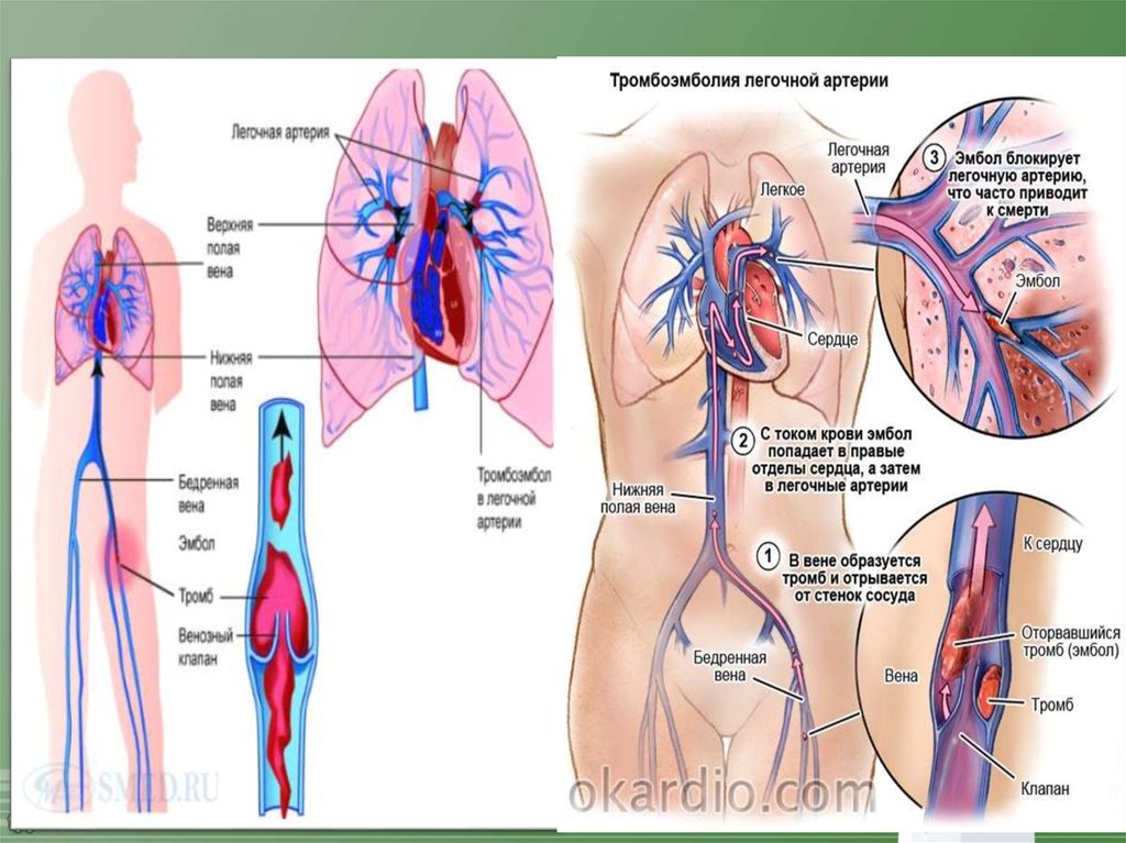 Артериальная тромбоэмболия. Тромбоэмболия легочной артерии. Периферическая тромбоэмболия. Тромбоэмболия артерии. Омбоэмболия лёгочной артерии.