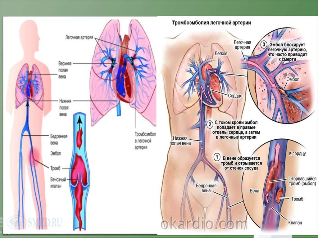 Тромбоэмболия это. Тромб в легочной артерии. Тромбоэмболия легочной артерии. Тромбоэмболия легочной артерии морфология. Легочная артерия артериальная или венозная.