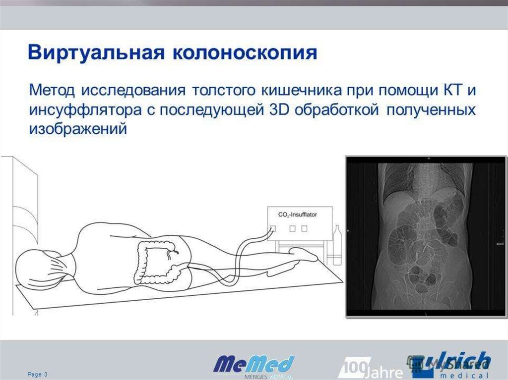 Виртуальная колоноскопия кишечника что это. Дивертикулит виртуальная колоноскопия. Виртуальная компьютерно-томографическая колоноскопия. Виртуальная колоноскопия кишечника. Виртуальная колоноскопия картинки.