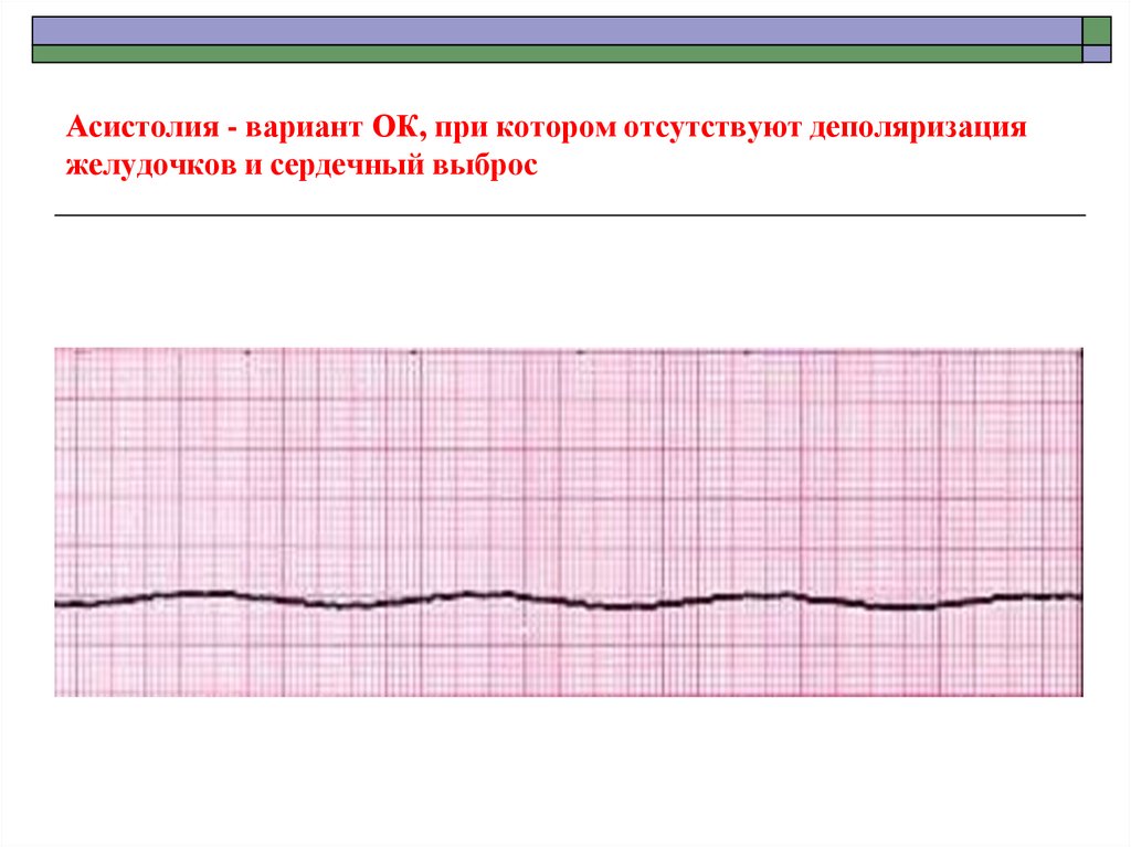 Асистолия на экг фото