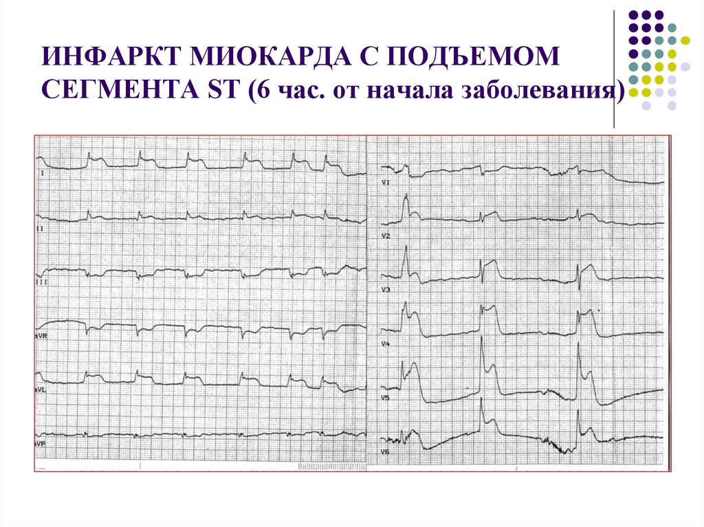 Подъем st. ЭКГ при инфаркте миокарда с подъемом St. ЭКГ при инфаркте миокарда без подъема сегмента St. ЭКГ острый инфаркт миокарда с подъемом сегмента St. ЭКГ при инфаркте с подъемом ст.