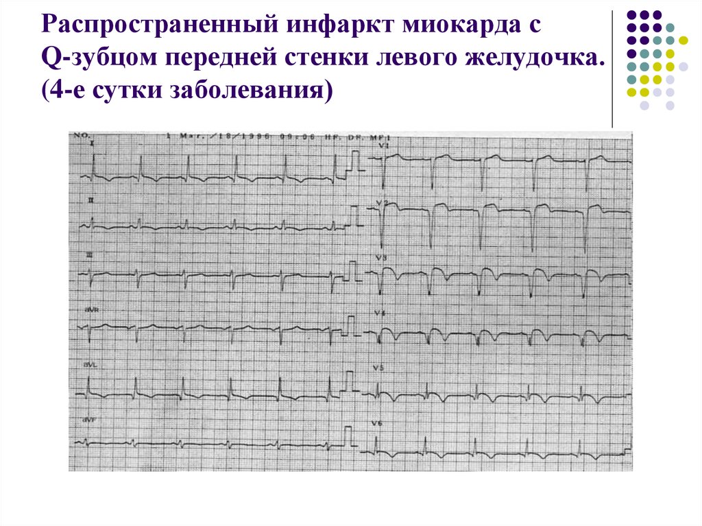 Изменение боковой стенки левого желудочка. ЭКГ передне перегородочный инфаркт. Инфаркт передней стенки на ЭКГ. Острый передний инфаркт миокарда с зубцом q. ЭКГ при распространенном переднем инфаркте миокарда.