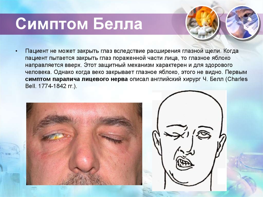 Симптомы поражения лицевого нерва
