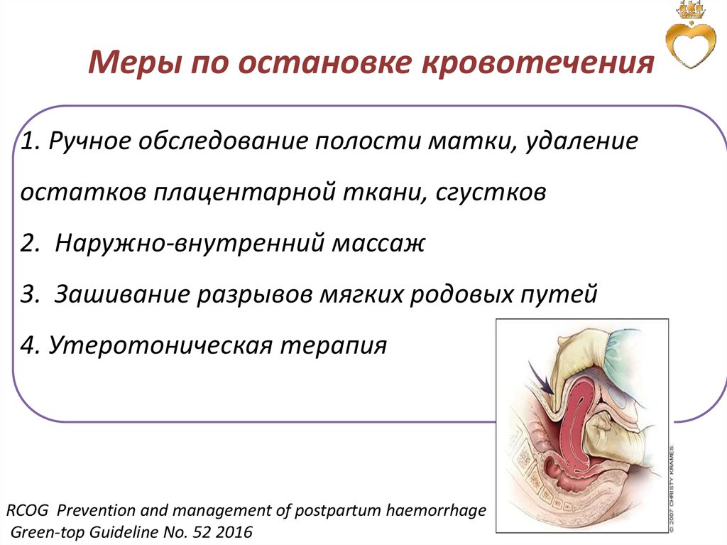 Баллонная тампонада матки презентация