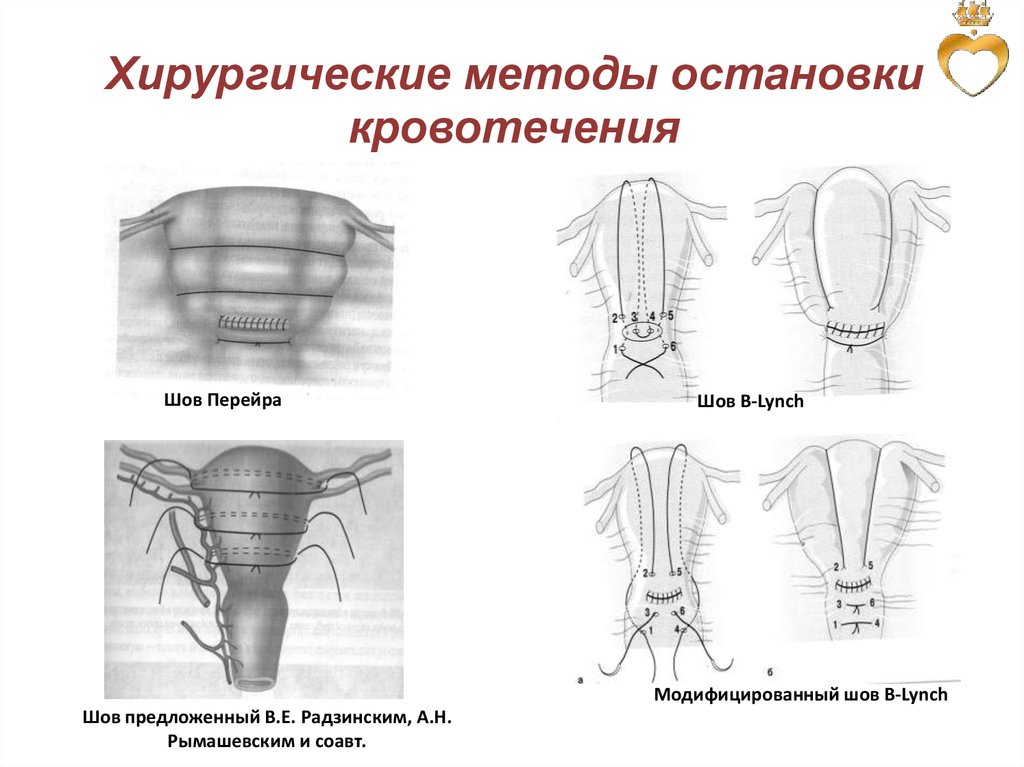 Гемостатическая схема регулона