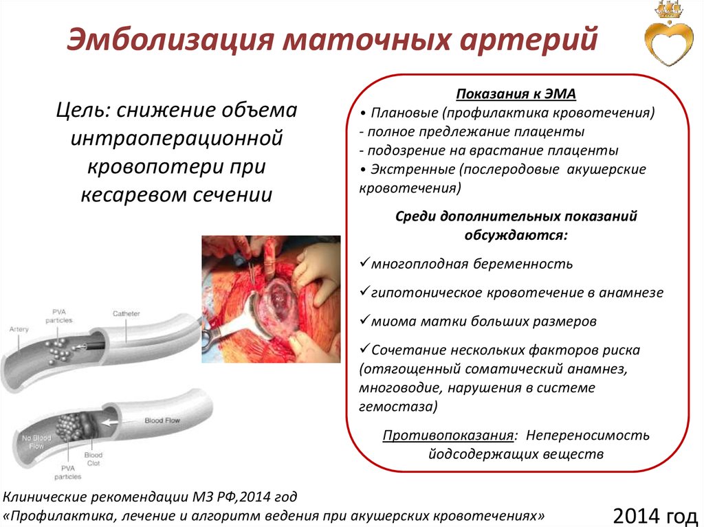 Эмболизация маточных артерий презентация