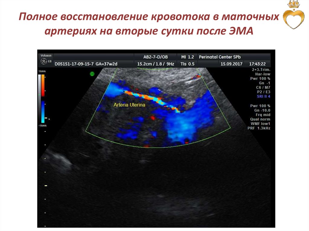 Гемодинамика при беременности. УЗИ допплерография маточно-плацентарного кровотока. Нарушение кровотока в маточных артериях при беременности. Кровоток в маточных артериях нарушен. Нарушение гемодинамики в маточных артериях.